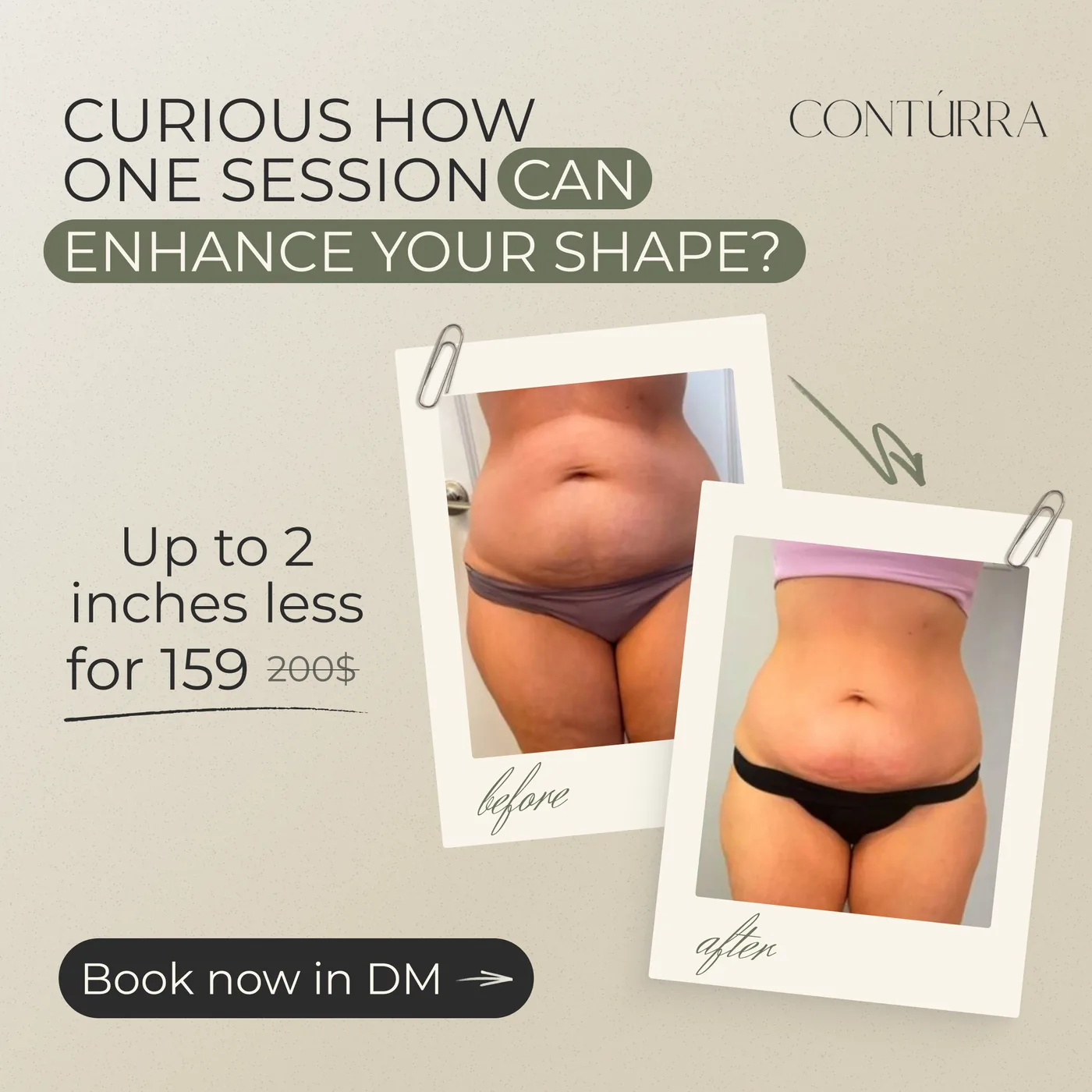 CONTÚRRA Cryotherapy