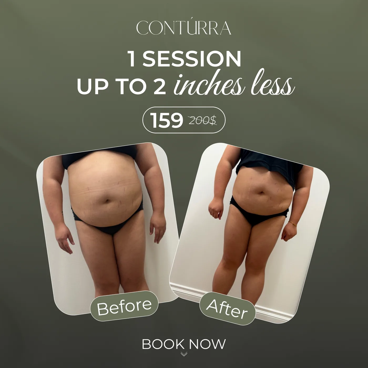 CONTÚRRA Cryotherapy
